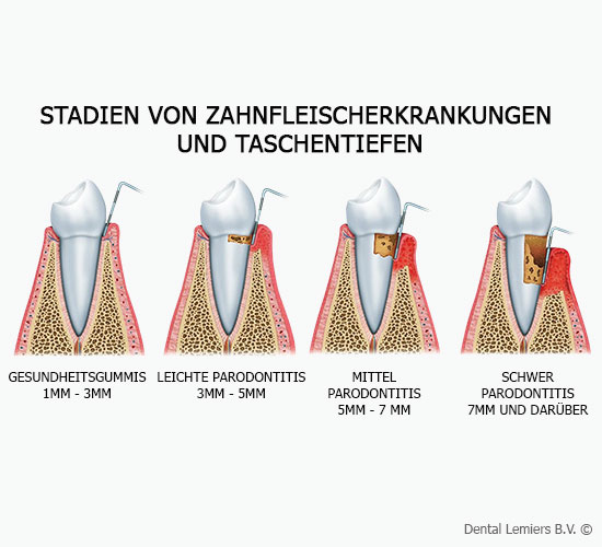 Stadien von Zahnfleisherkrankungen